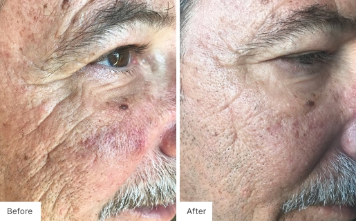 3 - Before and After Real Results photo of a man's face.